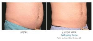 Sculptology-CoolSculpting-before-and-after-16