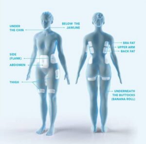 Are CoolSculpting Results Permanent