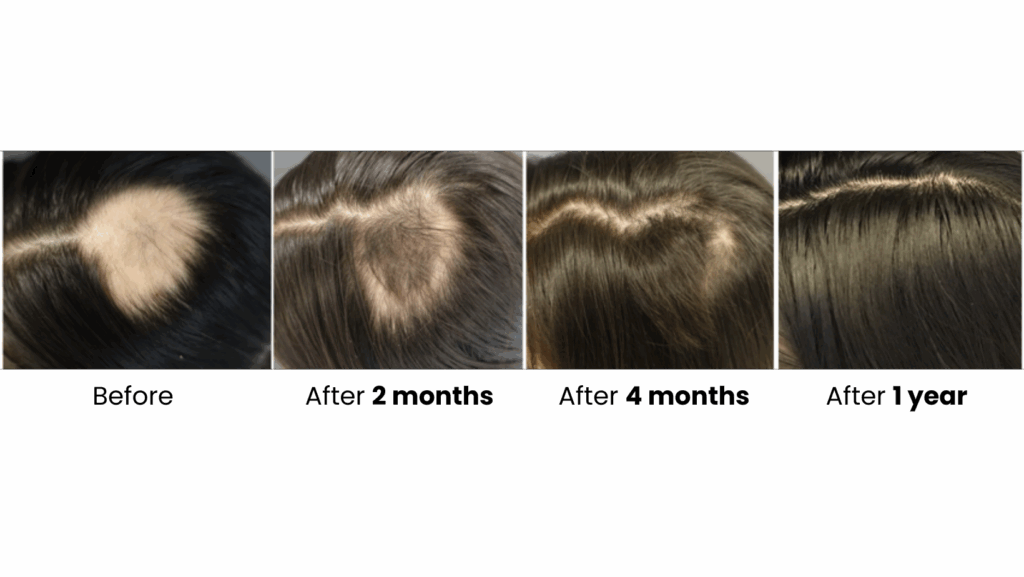 Before and after hair restoration results