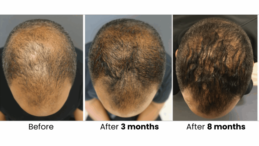 Before and after hair restoration results