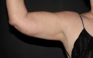 CW Female Arms After