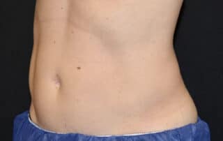 JS Female Abdomen After 2 Sessions