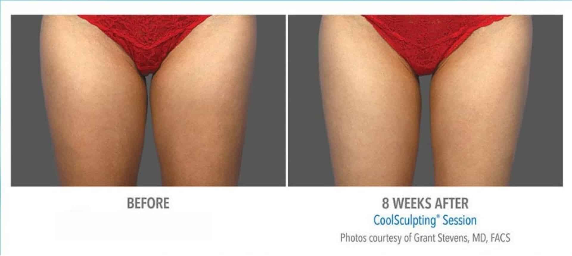coolsculpting before after