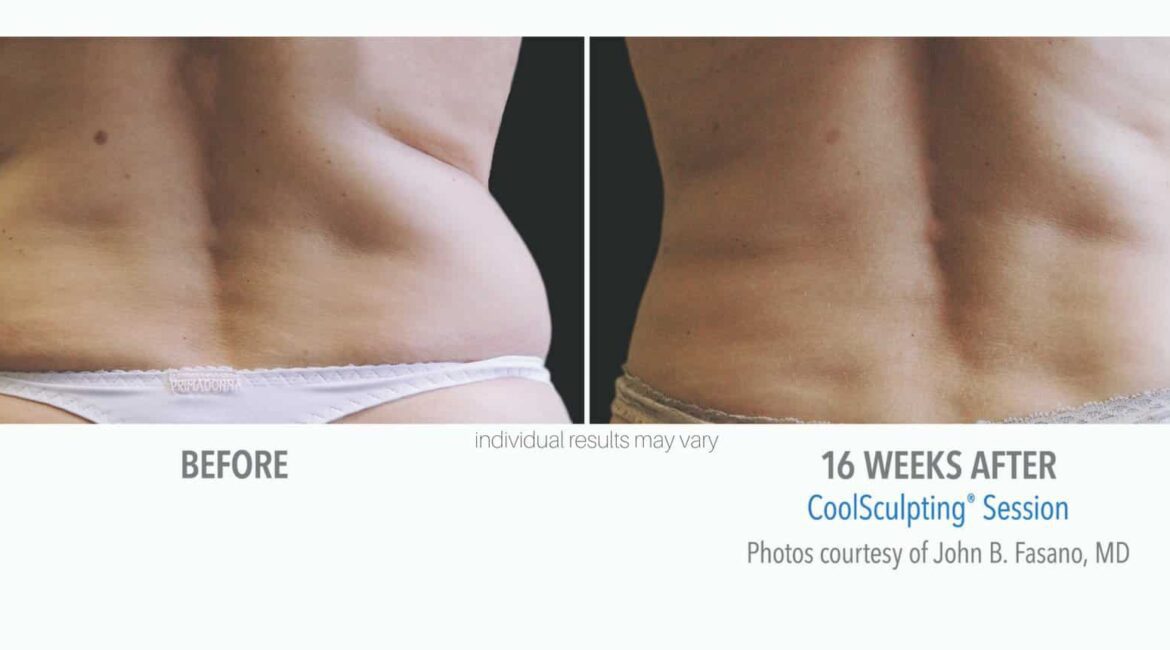 Sculptology-CoolSculpting-before-and-after-15