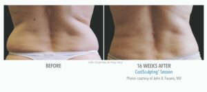 Sculptology-CoolSculpting-before-and-after-15 - Sculptology Sculptology-CoolSculpting-before-and-after-15