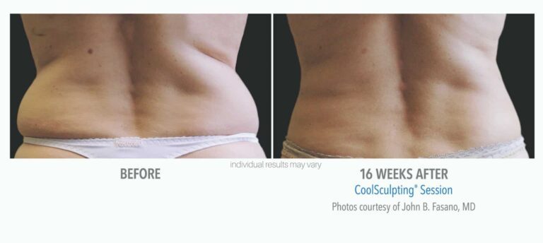 Sculptology-CoolSculpting-before-and-after-15