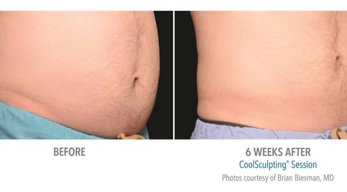 Sculptology-CoolSculpting-before-and-after-16