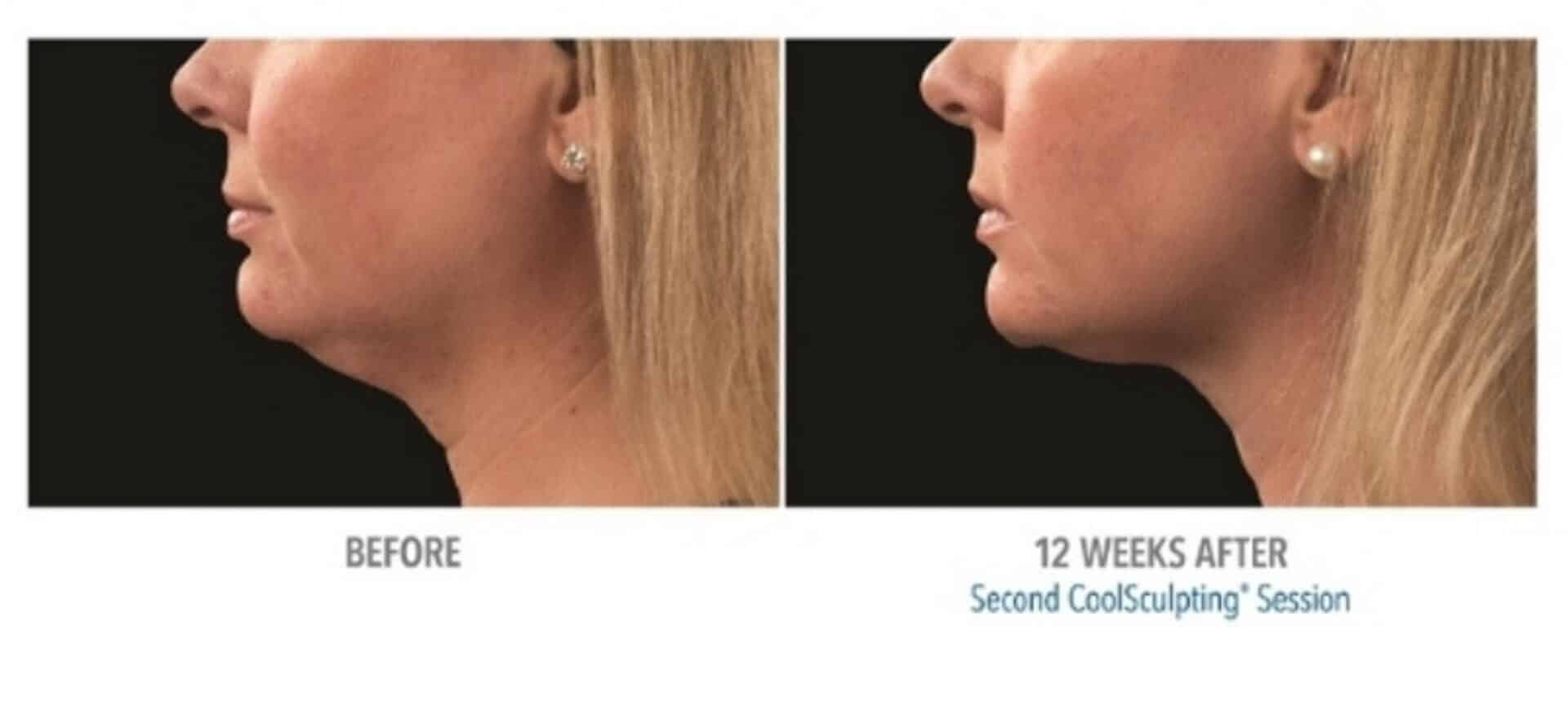 coolsculpting before after