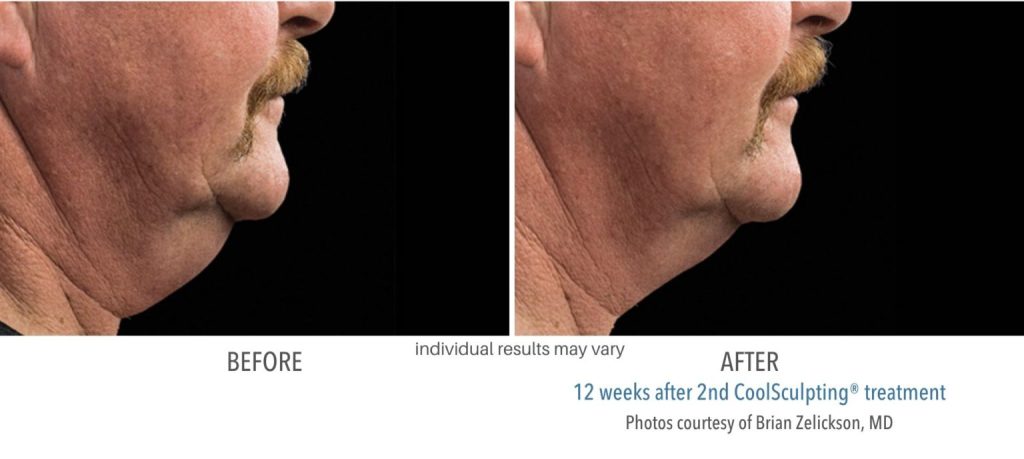 coolsculpting before after chin