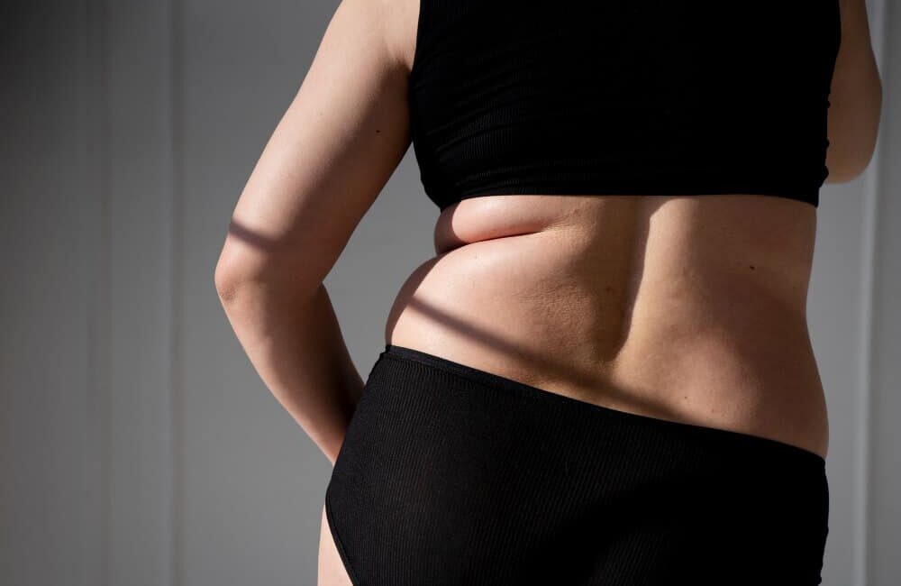 CoolSculpting for Back Fat- Targeting Those Hard to Reach Areas