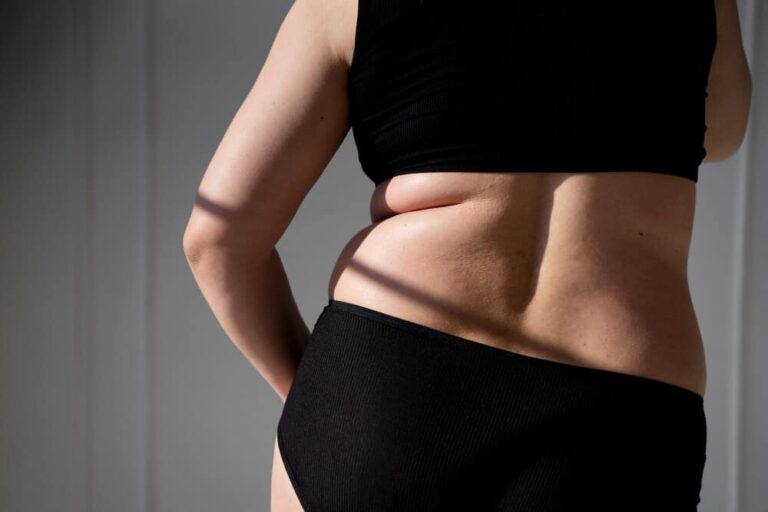 CoolSculpting for Back Fat- Targeting Those Hard to Reach Areas