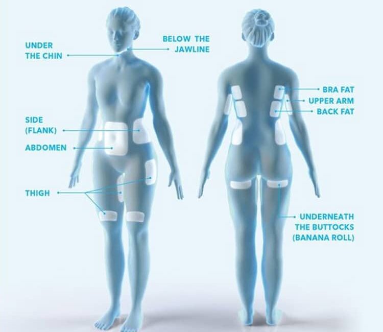 illustration of coolsculpting Treatment Area