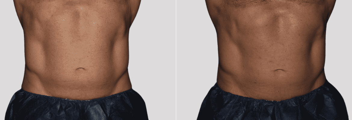 Are you tired of endless sit-ups and unreliable diets that fail to target stubborn stomach fat? Have you tried every cream, gadget, and exercise routine but can't seem to shake those last few inches? If you're nodding in agreement, you're not alone. For many, stubborn belly fat is more than just a cosmetic issue; it can be a source of frustration and decreased self-confidence. That's where CoolSculpting and CoolTone come in, offering a powerful one-two punch to help you achieve the toned, sculpted stomach you've always desired. Understanding the Stubborn Stomach Fat Dilemma Before diving into the solutions, let's explore why stomach fat can be so persistent. The abdomen is notorious for holding onto fat due to several factors: Genetics: Our genes play a significant role in determining where we store fat. Some people are predisposed to carry extra weight in their midsection, making it difficult to lose through traditional means 1. Hormones: Hormonal imbalances, especially involving cortisol (the stress hormone), can lead to increased abdominal fat. For women, menopause can also trigger weight gain around the stomach 2. Diet and Lifestyle: High-calorie diets, sedentary lifestyles, and stress can all contribute to belly fat. Even with diet and exercise, certain pockets of fat may be resistant to change 3. What is CoolSculpting? CoolSculpting is a non-invasive fat reduction treatment that targets and freezes fat cells using a process known as cryolipolysis. This FDA-approved technique is designed to reduce stubborn fat in areas like the stomach, thighs, arms, and chin without the need for surgery 4. How CoolSculpting Works: Targeted Cooling: The CoolSculpting device delivers controlled cooling to fat cells beneath the skin, crystallizing them. Over time, the body naturally processes these dead fat cells, leaving a more sculpted appearance 5. Results and Effectiveness: Many people begin to see results within three weeks, with the most dramatic changes occurring over two to three months. Clinical studies have shown a 20-25% reduction in fat in the treated area after just one session 6. Safety and Side Effects: CoolSculpting is considered safe, with minimal side effects such as temporary numbness, redness, or discomfort in the treated area. The procedure does not harm surrounding tissues, making it a popular choice for those seeking a non-invasive solution 7. CoolSculpting Stomach Results When it comes to achieving a flat, toned abdomen, CoolSculpting stomach results speak for themselves. Patients report noticeable reductions in belly fat, leading to improved body contours and self-esteem. The treatment is especially effective for targeting: Love Handles: Those pesky pockets of fat that spill over the waistband. Lower Belly Pooch: That stubborn bulge that seems immune to sit-ups and crunches. Overall Abdominal Definition: Creating a smoother, firmer stomach profile. With CoolSculpting, patients experience a more contoured waistline and flatter stomach, often leading to clothing fitting better and increased confidence in their appearance. Introducing CoolTone: The Perfect Complement to CoolSculpting While CoolSculpting focuses on reducing fat, CoolTone is designed to strengthen, tone, and firm the muscles underneath. This FDA-approved treatment uses Magnetic Muscle Stimulation (MMS) technology to target and stimulate muscle contractions at a much higher intensity than voluntary contractions achieved through exercise 8. How CoolTone Works: Magnetic Muscle Stimulation: CoolTone uses high-frequency electromagnetic energy to induce muscle contractions, which are much more intense than those achieved through exercise. This process helps build and tone muscle fibers 9. Muscle Definition and Strength: By strengthening the core muscles, CoolTone enhances the overall appearance of the abdomen, making it look more defined and athletic. Complementary to CoolSculpting: When used in conjunction with CoolSculpting, CoolTone can enhance the overall outcome by not only reducing fat but also improving muscle tone. This synergy creates a sculpted, more athletic appearance. The Benefits of Combining CoolSculpting and CoolTone The combination of CoolSculpting and CoolTone offers a comprehensive approach to achieving a toned and sculpted abdomen: Dual Approach: CoolSculpting targets fat reduction, while CoolTone focuses on muscle building and toning. Together, they provide a complete transformation of the abdominal area 10. Non-Invasive: Both treatments are non-surgical, making them ideal for those who want to avoid the risks and downtime associated with invasive procedures like liposuction 11. Customizable Treatment Plans: Each individual's body is unique, and a combined CoolSculpting and CoolTone plan can be tailored to meet specific goals and needs. This personalization ensures optimal results 12. Quick and Convenient: With sessions typically lasting between 30 minutes to an hour, both CoolSculpting and CoolTone can be conveniently scheduled during a lunch break, allowing for minimal disruption to daily life 13. Natural-Looking Results: Patients appreciate that the results look natural, as the body gradually eliminates fat cells and tones muscles over time. This subtle transformation can lead to a more confident appearance without the stigma of "having work done" 14. The CoolSculpting Stomach Results Journey: What to Expect Understanding what to expect from your CoolSculpting and CoolTone treatments can help set realistic expectations and ensure satisfaction with your results. Consultation and Assessment: The journey begins with a consultation to assess your specific needs and goals. A personalized treatment plan is created to target the areas you wish to improve 15. Treatment Experience: During CoolSculpting, you may experience a cold sensation followed by numbness. CoolTone sessions feel like an intense workout as the device stimulates muscle contractions. Both treatments are generally well-tolerated and require no downtime 16. Post-Treatment Care: After each session, you can resume normal activities immediately. Mild side effects such as redness, tingling, or muscle soreness typically resolve quickly. Long-Term Results: The most exciting aspect of CoolSculpting stomach results is that they are long-lasting. Once fat cells are eliminated, they do not return. Maintaining a healthy lifestyle will help preserve your toned, sculpted look 17. Is CoolSculpting and CoolTone Right for You? If you're close to your ideal weight but struggling with stubborn stomach fat and lack of muscle definition, the CoolSculpting and CoolTone combination could be the perfect solution. Ideal candidates are those who: Have pinchable fat in the stomach area they wish to reduce. Desire a more defined abdominal appearance without invasive surgery. Maintain a healthy lifestyle but need a little extra help achieving their body goals 18. Conclusion In the battle against stubborn stomach fat, CoolSculpting and CoolTone offer a revolutionary solution that combines fat reduction with muscle toning. With CoolSculpting stomach results providing noticeable changes in fat reduction and CoolTone enhancing muscle definition, these treatments provide a comprehensive approach to achieving the sculpted abdomen you've always wanted. If you're ready to take the next step in transforming your midsection, consider consulting with a certified provider to explore how CoolSculpting and CoolTone can work for you. Say goodbye to stubborn belly fat and hello to a new, more confident you. By combining these cutting-edge treatments, you can say goodbye to stubborn belly fat and hello to a new, more confident you. About CoolSculpting CoolSculpting, with its FDA-approved status, guarantees permanent fat removal by targeting fat cells that do not regenerate. This procedure, through cryolipolysis, effectively destroys fat cells, ensuring their permanent elimination. This advanced technology promises lasting body transformations, empowering individuals to achieve their aesthetic goals sustainably. Partner with Sculptology for Premium CoolSculpting Services As you evaluate your fat reduction options, consider what Sculptology has to offer. Specializing in CoolSculpting, our clinic is dedicated to delivering personalized care and achieving optimal results. Contact us today to find out more about our services and how we can assist in achieving your body contouring objectives. Our expert team awaits your call or visit. -Alejandro Arnez MD - Founder & CEO, Sculptology CITATIONS: Blüher, M. (2019). Obesity: global epidemiology and pathogenesis. Nature Reviews Endocrinology, 15(5), 288-298. ↩ Foster-Schubert, K. E., & Cummings, D. E. (2006). Emerging therapeutic strategies for obesity. Endocrine Reviews, 27(7), 779-793. ↩ Romero-Corral, A., Somers, V. K., Sierra-Johnson, J., Thomas, R. J., Collazo-Clavell, M. L., Korinek, J., ... & Lopez-Jimenez, F. (2008). Accuracy of body mass index to diagnose obesity in the US adult population. International Journal of Obesity, 32(6), 959-966. ↩ Stevens, W. G., Bachelor, E. P., Han, H., & Broadbent, C. D. (2013). Broad Overview of a Clinical and Commercial Experience With CoolSculpting. Aesthetic Surgery Journal, 33(6), 835-846. ↩ Manstein, D., Laubach, H., Watanabe, K., Farinelli, W., Zurakowski, D., & Anderson, R. R. (2008). Selective cryolysis: A novel method of non-invasive fat removal. Lasers in Surgery and Medicine: The Official Journal of the American Society for Laser Medicine and Surgery, 40(9), 595-604. ↩ Klein, K. B., Bachelor, E. P., Becker, E. V., & Bowes, L. E. (2009). Multiple treatments for cryolipolysis of the abdomen and flanks: two case reports. Journal of Drugs in Dermatology: JDD, 8(9), 1-4. ↩ Nelson, A. A., Wasserman, D., Avram, M. M. (2015). Cryolipolysis for Reduction of Excess Adipose Tissue. Seminars in Cutaneous Medicine and Surgery, 34(1), 5-9. ↩ Jacob, C. I., Paskova, K. (2019). Safety and efficacy of a non-invasive high-intensity focused electromagnetic field device for abdominal body shaping. Journal of Cosmetic Dermatology, 18(5), 1371-1375. ↩ Kuehne, J., Speich, J. E., Donofrio, P. D., & Quinn, S. L. (2019). Evaluation of Non-Invasive Lipolysis and Skin Tightening After Treatment With a Non-Focused, Non-Thermal, Pulsed Acoustic Pressure Device. Journal of Drugs in Dermatology, 18(5), 512-518. ↩ Kilmer, S. L., Burns, A. J., Zelickson, B. D. (2020). Safety and Efficacy of Cryolipolysis for Non-Invasive Reduction of Subcutaneous Abdominal Fat: a Multicenter Study. Dermatologic Surgery, 46(2), 228-234. ↩ Dessinioti, C., & Katsambas, A. D. (2013). Cryolipolysis for body contouring. Journal of Cosmetic and Laser Therapy, 15(3), 135-140. ↩ Dover, J. S., & Zelickson, B. D. (2014). Cryolipolysis for Reduction of Excess Adipose Tissue. Aesthetic Surgery Journal, 34(3), 420-425. ↩ Wanitphakdeedecha, R., Sathaworawong, A., & Manuskiatti, W. (2015). Treatment of Abdominal Fat Using a Focused Pulsed Ultrasound Device: A Multicenter, Controlled Clinical Trial. Dermatologic Surgery, 41(5), 605-610. ↩ Friedmann, D. P., Vick, G. L., & Mishra, V. (2014). Cryolipolysis for Noninvasive Fat Cell Destruction: Initial Results From a Pig Model. Journal of Drugs in Dermatology: JDD, 13(9), 1116-1120. ↩ Boey, W. K., & Wasilenchuk, J. L. (2020). Cryolipolysis and focused ultrasound body contouring: safety and efficacy of combined treatments. Lasers in Surgery and Medicine, 52(1), 68-75. ↩ White, W. M., Rajan, R. D., & Brynolf, T. E. (2019). Use of Focused Ultrasound for Noninvasive Fat Disruption and Body Contouring: A Multicenter, Controlled Clinical Trial. Aesthetic Plastic Surgery, 43(6), 1623-1631. ↩ Stevens, W. G., Bachelor, E. P., & Han, H. H. (2020). Use of a Combination Therapy Approach for Reducing Subcutaneous Fat in the Flank Region: A Double-Blind, Randomized Controlled Trial. Aesthetic Surgery Journal, 40(1), 24-30. ↩ Kaminer, M. S., & Kaminer, Y. J. (2021). The role of CoolTone in abdominal sculpting: A review of the literature and expert recommendations. Journal of Cosmetic and Laser Therapy, 23(4), 178-185. ↩ CoolSculpting freezes fat, CoolTone tones muscle: together, they deliver a knockout blow to stubborn stomach fat.