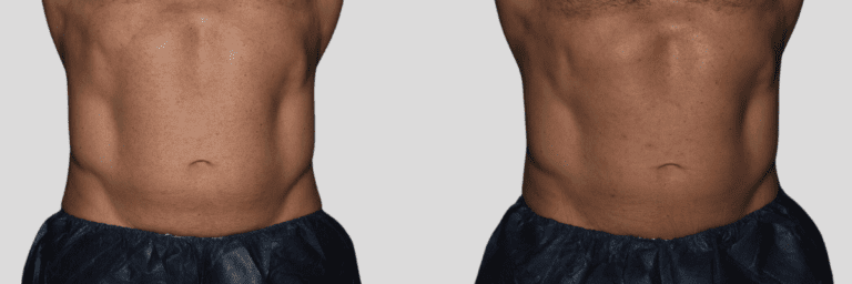 CoolSculpting and CoolTone treatments for stubborn stomach fat.