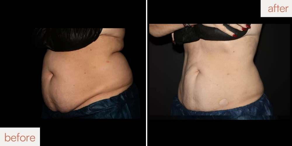 Before and after CoolSculpting results for female belly fat showing a smoother midsection in San Ramon.