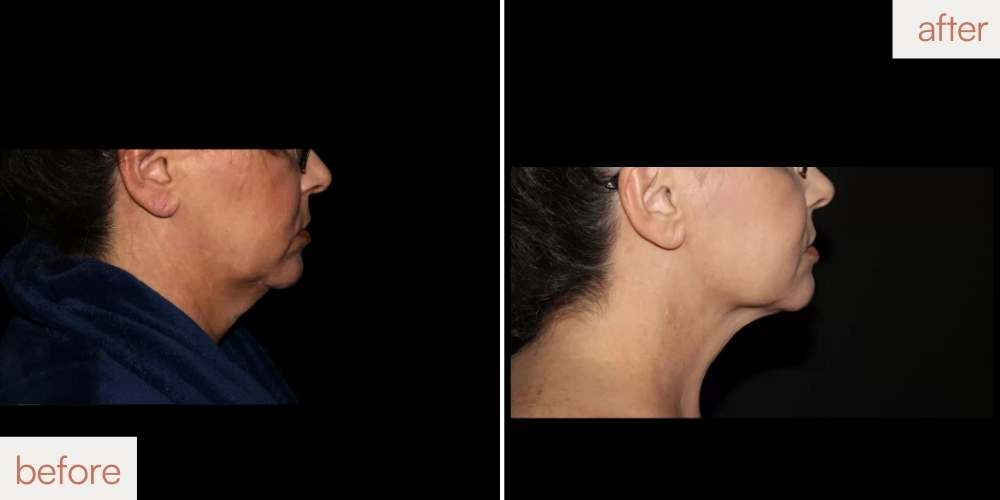 CoolSculpting woman chin before and after showing a sharper, defined jawline in the Bay Area.