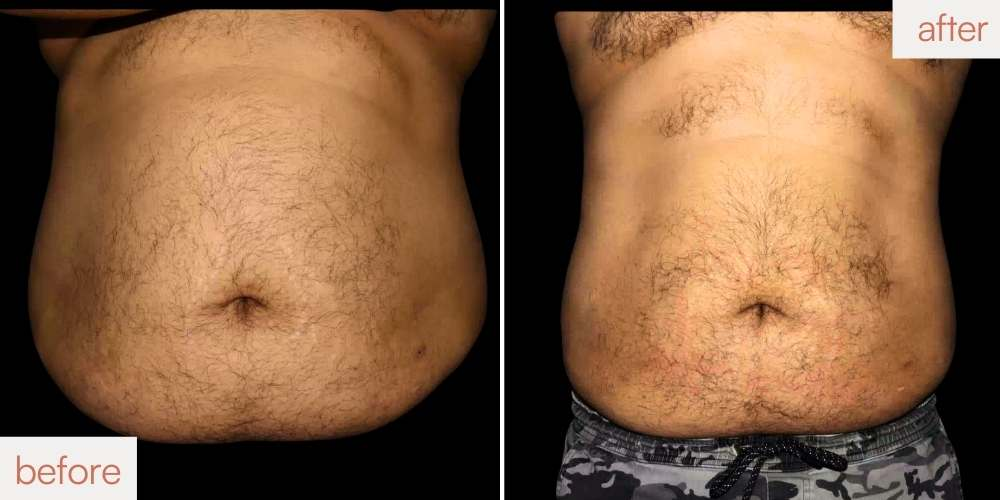 Permanent belly fat reduction for men using CoolSculpting at our San Ramon studio.
