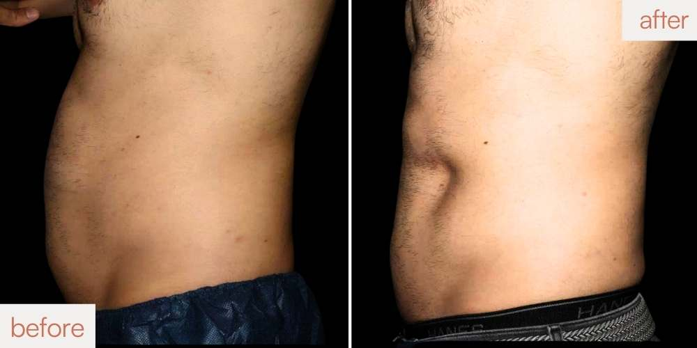 Non-surgical male abdominal contouring showing restored structural integrity at Sculptology Lafayette.