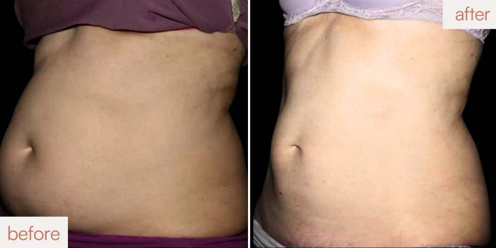 CoolSculpting woman abdomen before and after results showing a leaner silhouette at Sculptology San Ramon.