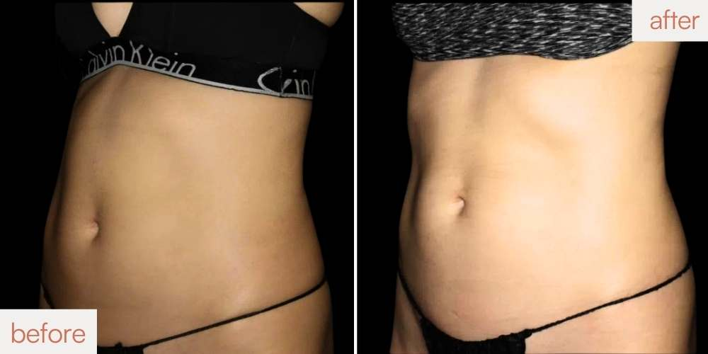 Achieving a toned female midsection with magnetic muscle stimulation at our Lafayette location.