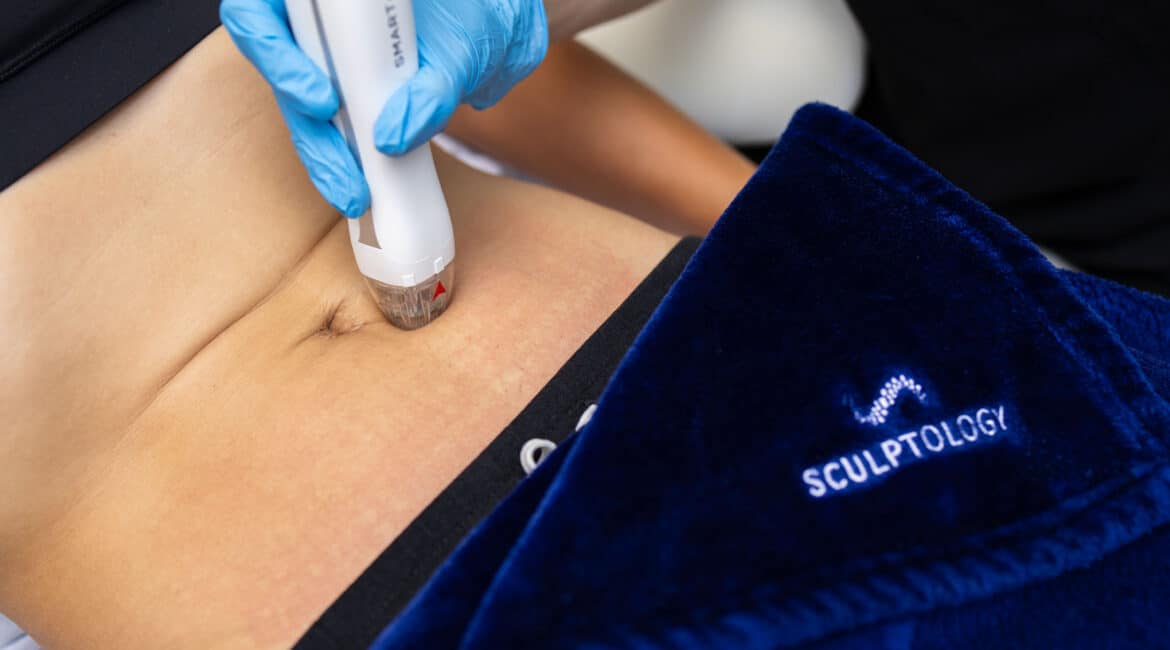 coolsculpting pics