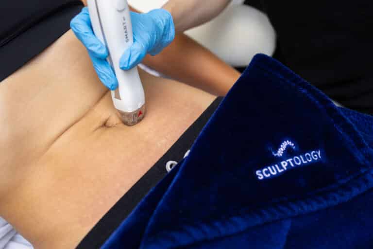 coolsculpting pics