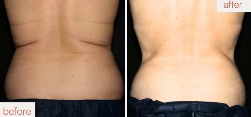 CoolSculpting for back fat and flanks transformation at our Lafayette studio.