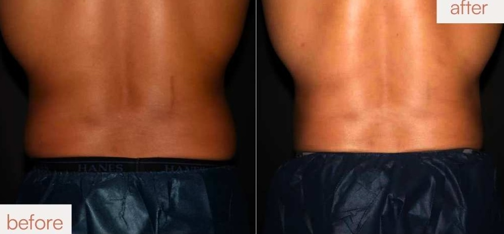 Bioaesthetic back contouring before and after photos showing smooth, natural results in the Bay Area.