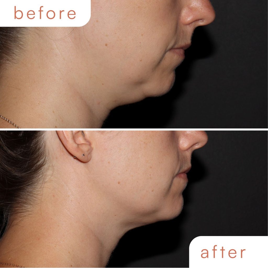 Before and after results of coolsculpting for chin fat reduction in Bay Area.