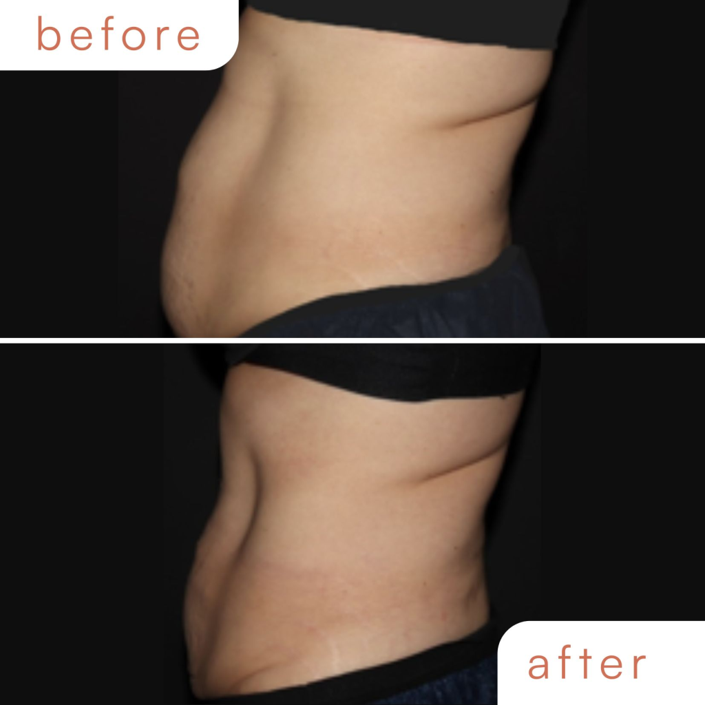 CoolSculpting body contouring before and after results at our Lafayette studio.