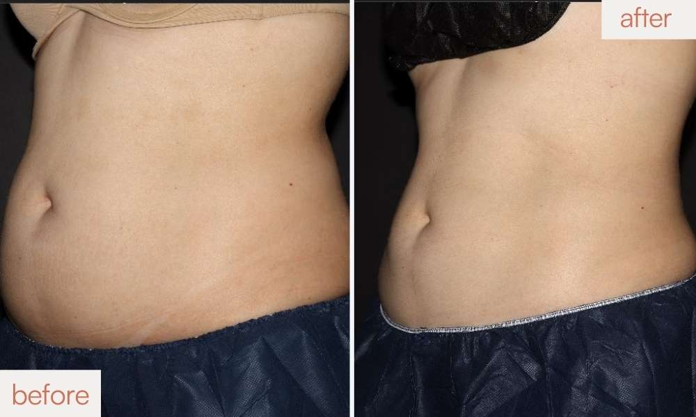 Non-surgical fat reduction Coolsculpting Pics before and after photos from Sculptology, California.