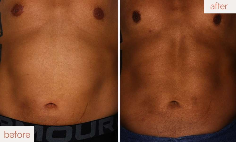 CoolTone muscle definition before and after results for a toned abdomen in San Ramon.