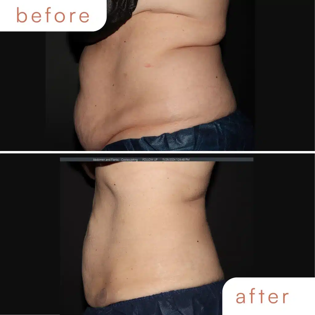 CoolSculpting Elite before and after results for stomach fat reduction at Sculptology Lafayette