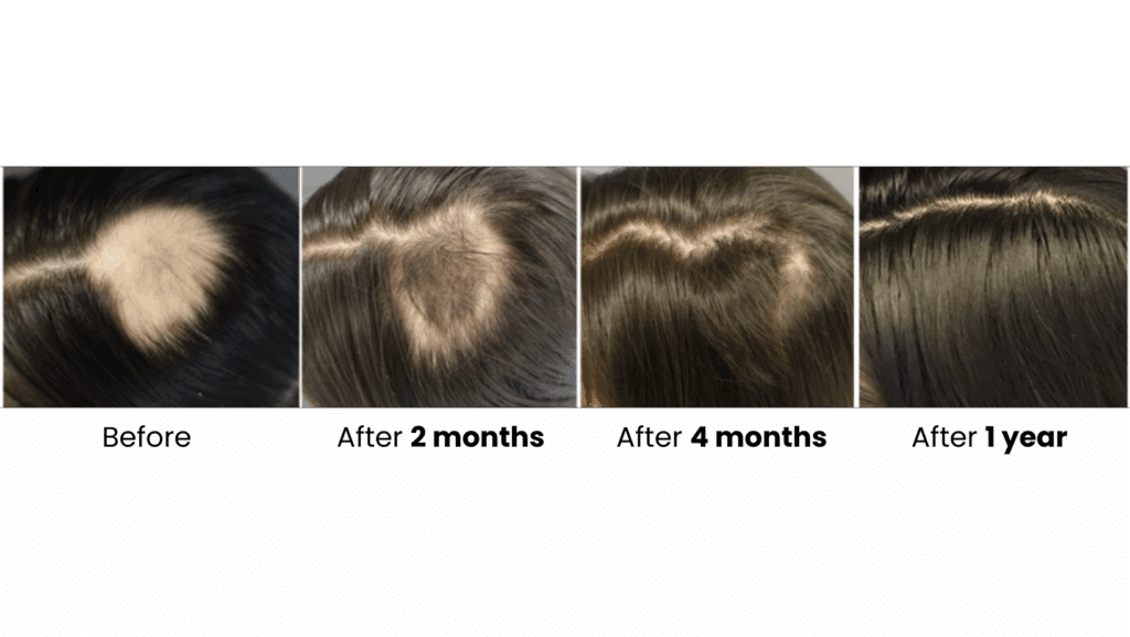 Before and after hair restoration results