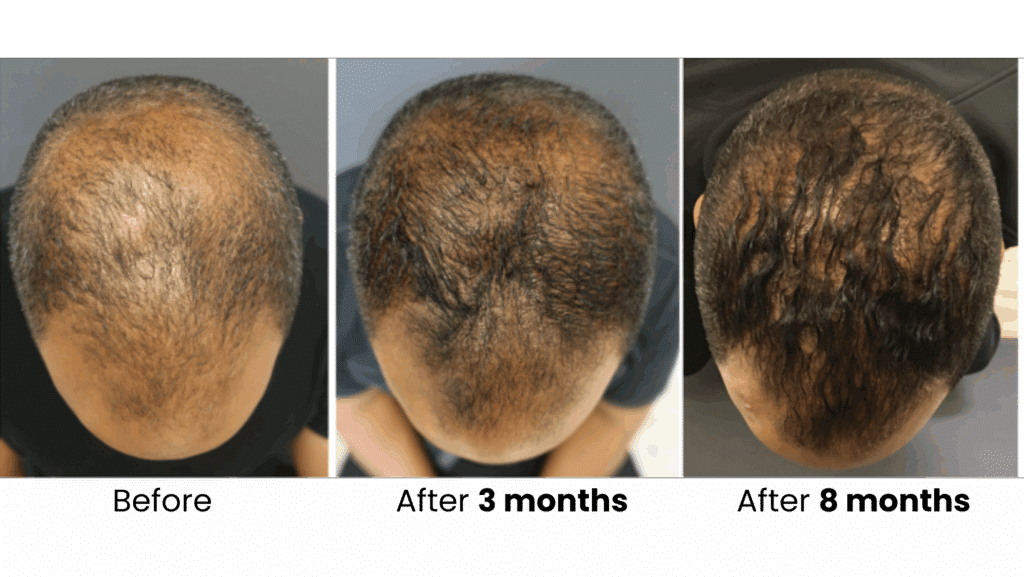 Before and after hair restoration results