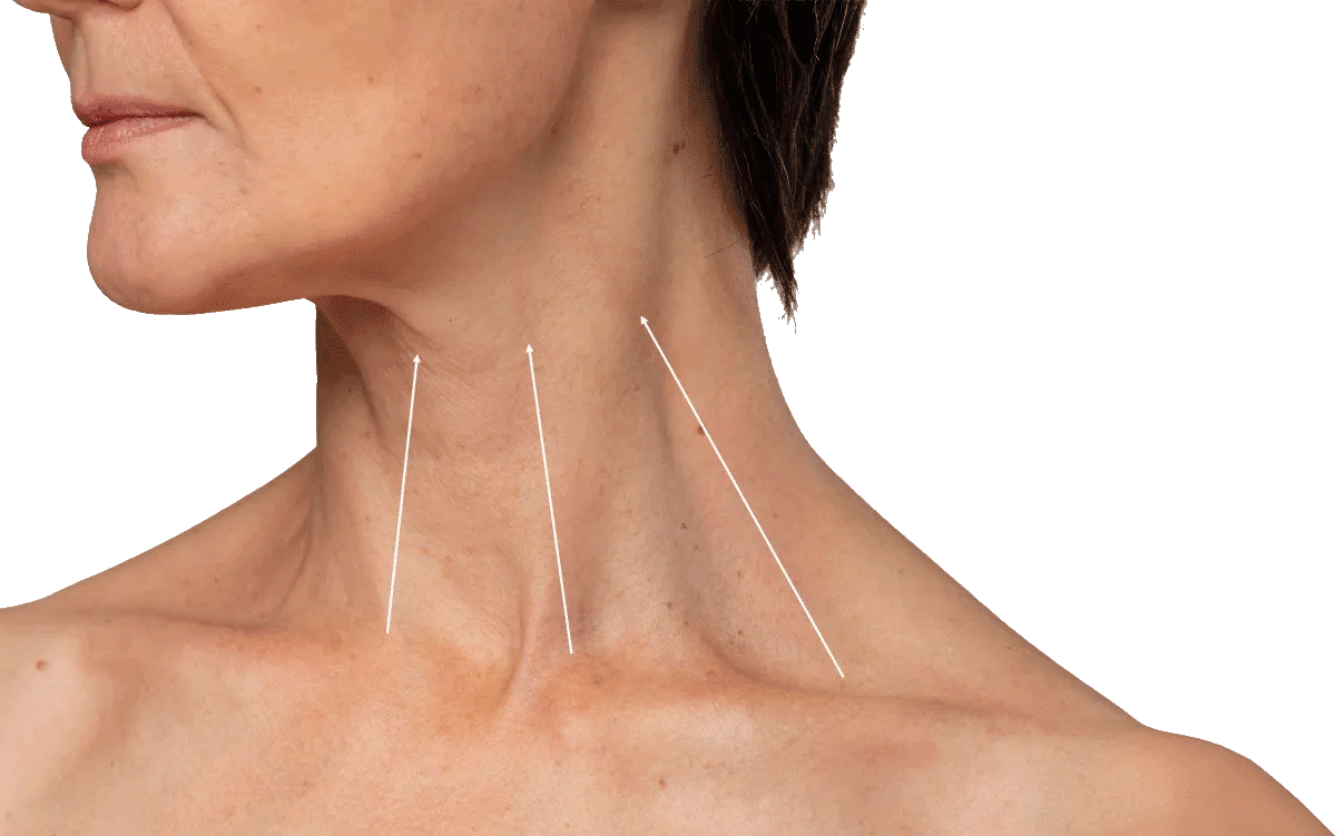 68714de2efdc1e3e0e10ec16 - Sculptology Patient receiving aesthetic injectables for neck areas rejuvenation at Sculptology