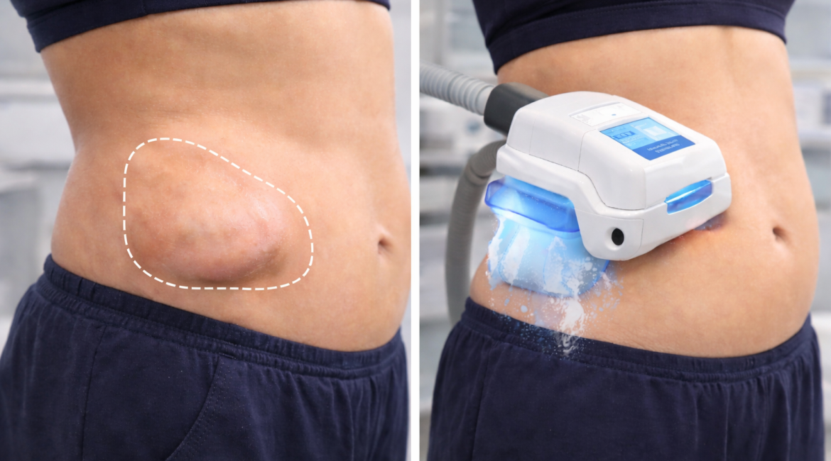 PAH and CoolSculpting side effects revealed