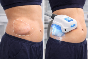 PAH and CoolSculpting side effects revealed