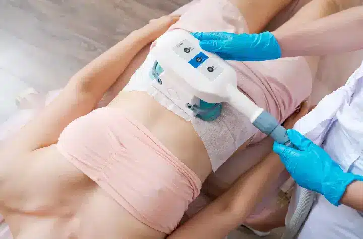 coolsculpting treatment