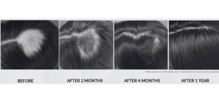 Series of four grayscale scalp photos showing hair regrowth: before, after 2 months, after 4 months, after 1 year.,”Series of four grayscale scalp photos showing hair regrowth: before, after 2 months, after 4 months, after 1 year.”